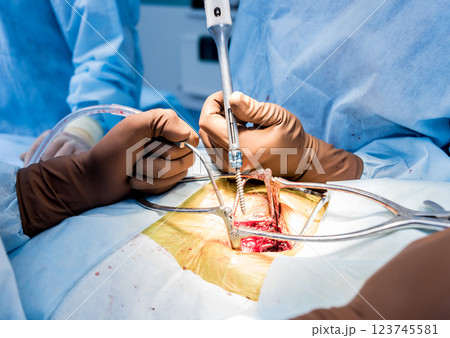 Spinal surgery. Surgeon tightens the polyaxial screw into the patient's spine. Spinal surgery. Surgeon tightens the polyaxial screw into the patient's spine. 123745581