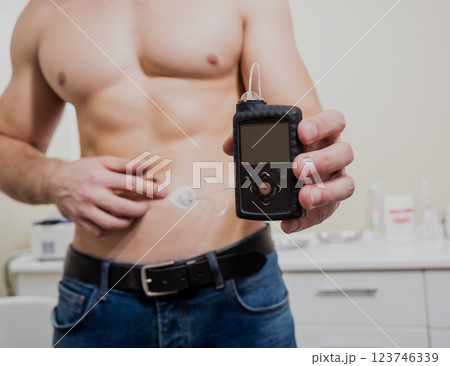 Diabetic man with an insulin pump connected in his abdomen and keeping the insulin pump 123746339