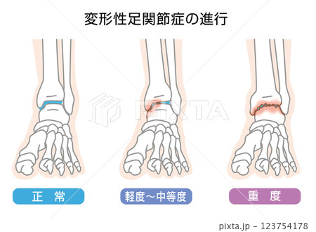変形性足関節症の進行 イラスト 変形性足関節症の進行 イラスト 123754178