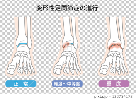 変形性足関節症の進行 イラスト 変形性足関節症の進行 イラスト 123754178