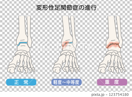 変形性足関節症の進行　イラスト 123754180