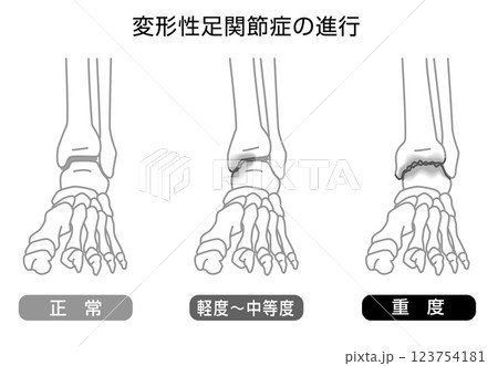 変形性足関節症の進行　イラスト　モノトーン 123754181