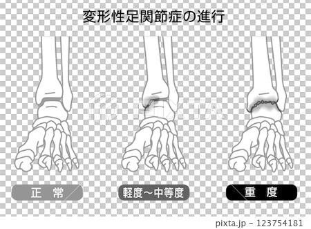 変形性足関節症の進行　イラスト　モノトーン 123754181