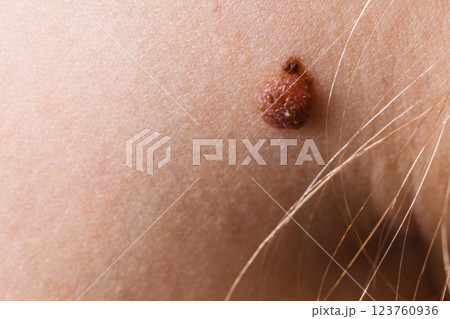 Closeup brown mole on caucasian woman skin. Closeup brown mole on caucasian woman skin. 123760936