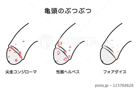 男性生殖器にできたぶつぶつ　性病の種類 123768626
