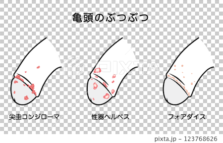 男性生殖器にできたぶつぶつ　性病の種類 123768626