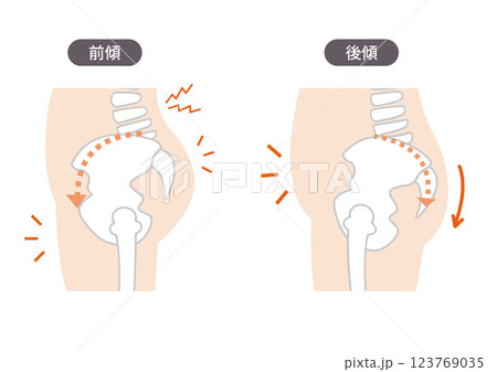 歪んだ骨盤の位置と症状を表した体の側面の図説イラスト 歪んだ骨盤の位置と症状を表した体の側面の図説イラスト 123769035