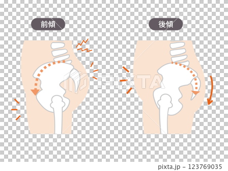 身體側面的插圖顯示了骨盆扭曲的位置和症狀 123769035