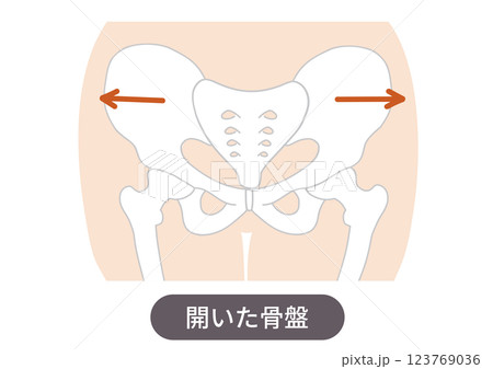 歪んだ骨盤の位置と状態を表した図説イラスト 123769036