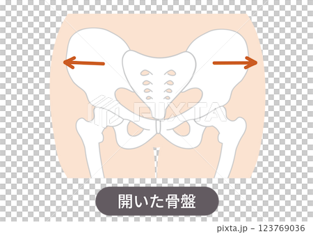 歪んだ骨盤の位置と状態を表した図説イラスト 123769036
