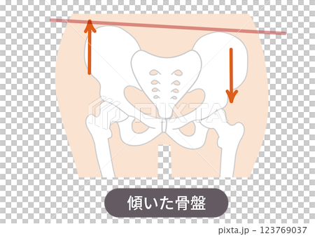 歪んだ骨盤の位置と症状を表した図説イラスト 123769037