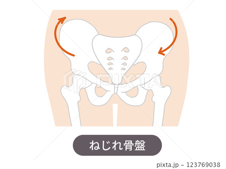 歪んだ骨盤の位置と症状を表した図説イラスト 123769038