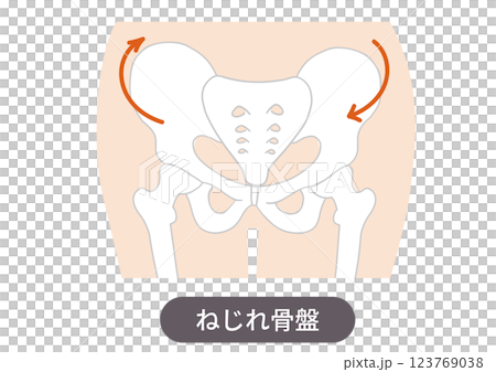 歪んだ骨盤の位置と症状を表した図説イラスト 123769038