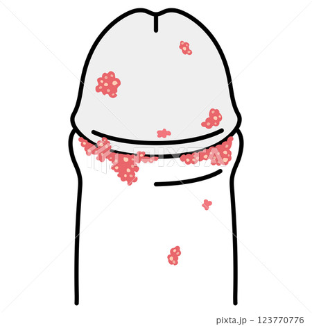 尖圭コンジローマ 男性生殖器にできたぶつぶつ 尖圭コンジローマ 男性生殖器にできたぶつぶつ 123770776