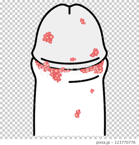 尖圭コンジローマ 男性生殖器にできたぶつぶつ 尖圭コンジローマ 男性生殖器にできたぶつぶつ 123770776