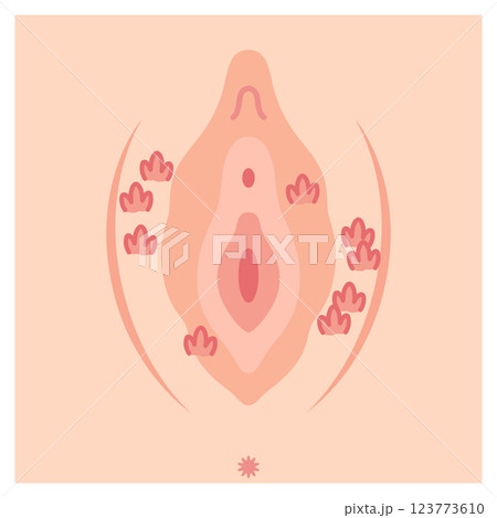 女性外性器の病気 尖圭コンジローマ 女性外性器の病気 尖圭コンジローマ 123773610