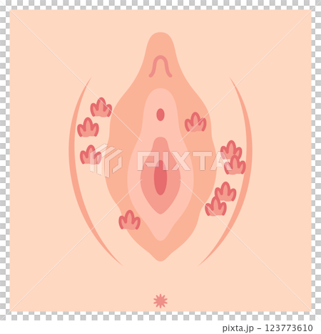 女性外性器の病気 尖圭コンジローマ 女性外性器の病気 尖圭コンジローマ 123773610