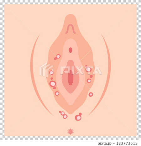 Diseases of the female external genitalia: Genital herpes Diseases of the female external genitalia: Genital herpes 123773615