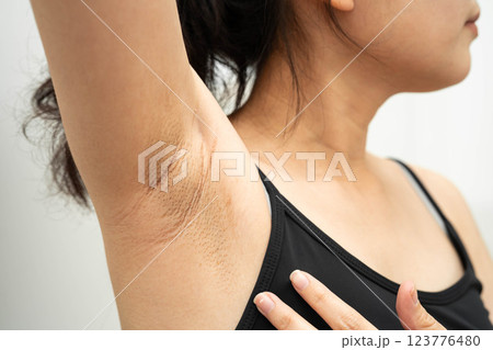 Asian woman have problem black armpit beauty skin care. 123776480