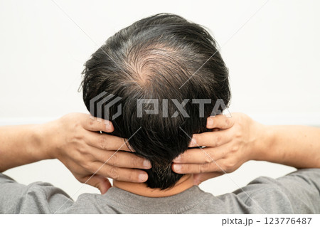 Bald head in man, hair loss treatment health problem. 123776487