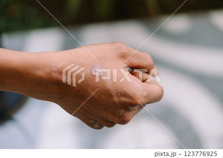 A close-up of a healed scar on the right hand 123776925