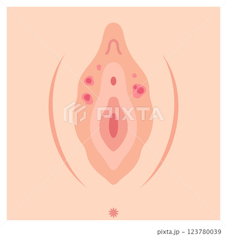女性外性器の病気　梅毒 123780039