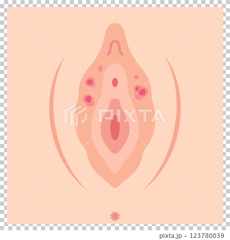 女性外性器の病気　梅毒 123780039