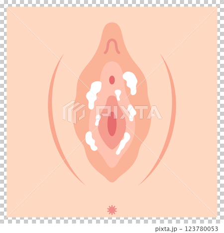 Diseases of the female external genitalia: Candidiasis 123780053