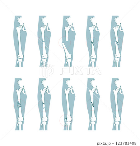 Types of bone fractures medical educational vector 123783409