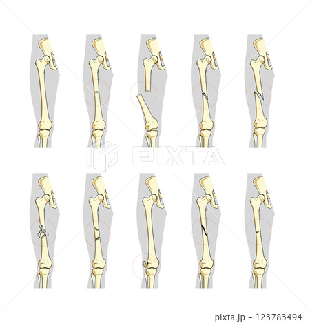 Types of bone fractures medical educational vector 123783494