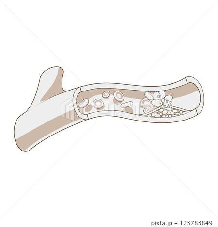 Blood vessel and clot thrombus vector illustration 123783849
