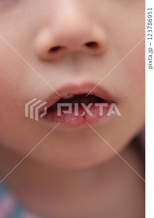 唇が荒れている3歳の女の子 唇が荒れている3歳の女の子 123786951