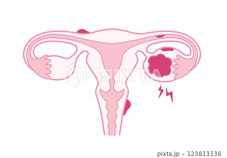 子宮内膜症・チョコレート囊胞で痛みがある子宮 123813138
