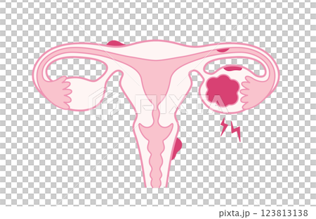 子宮内膜症・チョコレート囊胞で痛みがある子宮 123813138