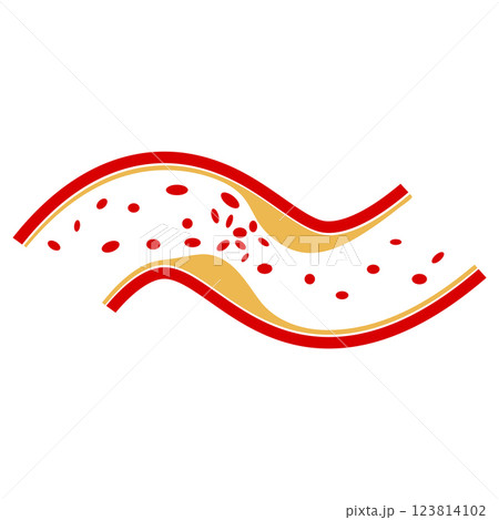 vector of cholesterol plaque 123814102