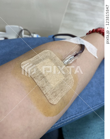 Blood Donation Process: A Woman Arm with a Needle Drawing Blood Blood Donation Process: A Woman Arm with a Needle Drawing Blood 123815847