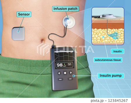 Insulin pump with wireless sensor Insulin pump with wireless sensor 123845267