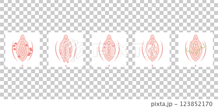 女性外生殖器疾病 女性外生殖器疾病 123852170