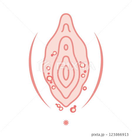 女性外性器の病気 性器ヘルペス 女性外性器の病気 性器ヘルペス 123866913