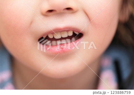 唇が荒れている3歳の女の子 123886759