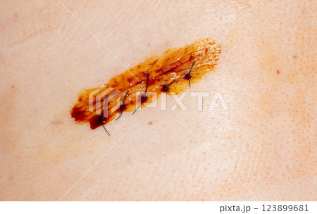 Treating the wound with iodine for healing. Surgical suture after surgery. Cosmetic stitches and threads on human skin. Plastic surgery 123899681