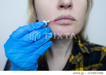 Herpes on the lips of women. A dermatologist examines and treats with ointment fever blisters of the herpes simplex virus 123901486