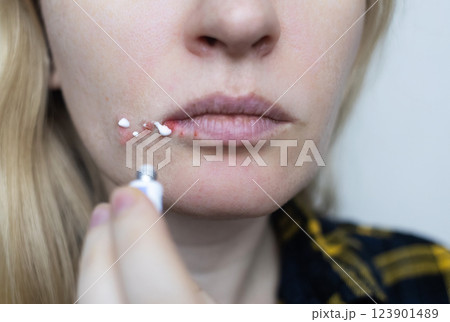 Herpes on the lips of women. A dermatologist examines and treats with ointment fever blisters of the herpes simplex virus 123901489