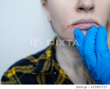 Herpes on the lips of women. A dermatologist examines and treats with ointment fever blisters of the herpes simplex virus Herpes on the lips of women. A dermatologist examines and treats with ointment fever blisters of the herpes simplex virus 123901515
