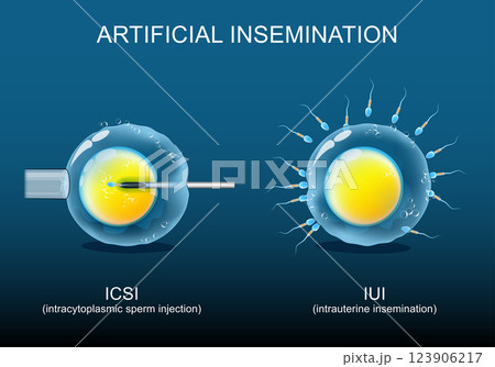 Artificial insemination. Sperm donation. Fertility treatment. 123906217