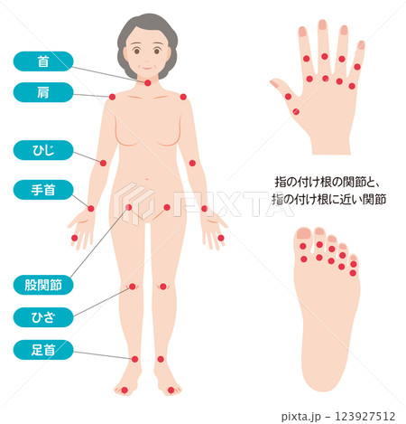 関節リウマチの症状があらわれる主な関節 123927512