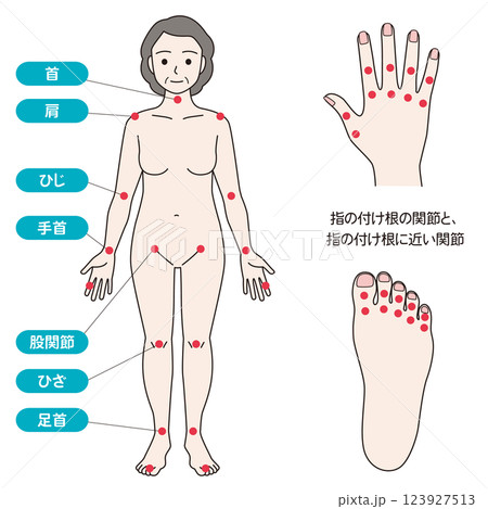 関節リウマチの症状があらわれる主な関節 123927513