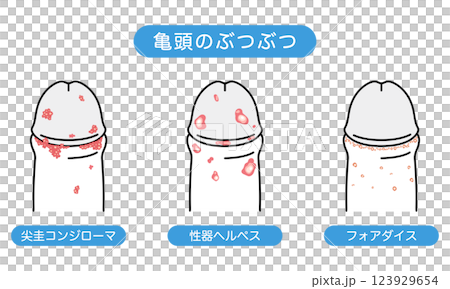 Bumps on male genitals - types of sexually transmitted diseases 123929654