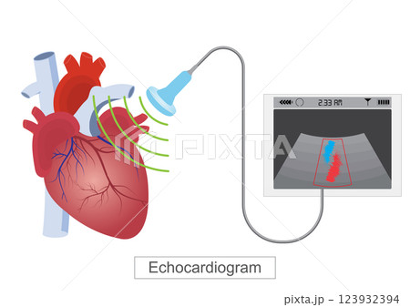 An echocardiogram (echo) is a test that use high frequency sound waves. An echocardiogram (echo) is a test that use high frequency sound waves. 123932394