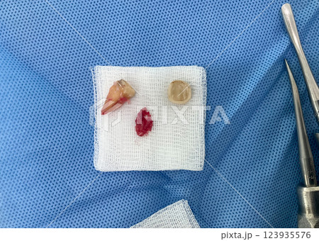 Extracted teeth and gauze placed on a blue surgical drape, indicating preparation for a dental procedure. Top view Extracted teeth and gauze placed on a blue surgical drape, indicating preparation for a dental procedure. Top view 123935576